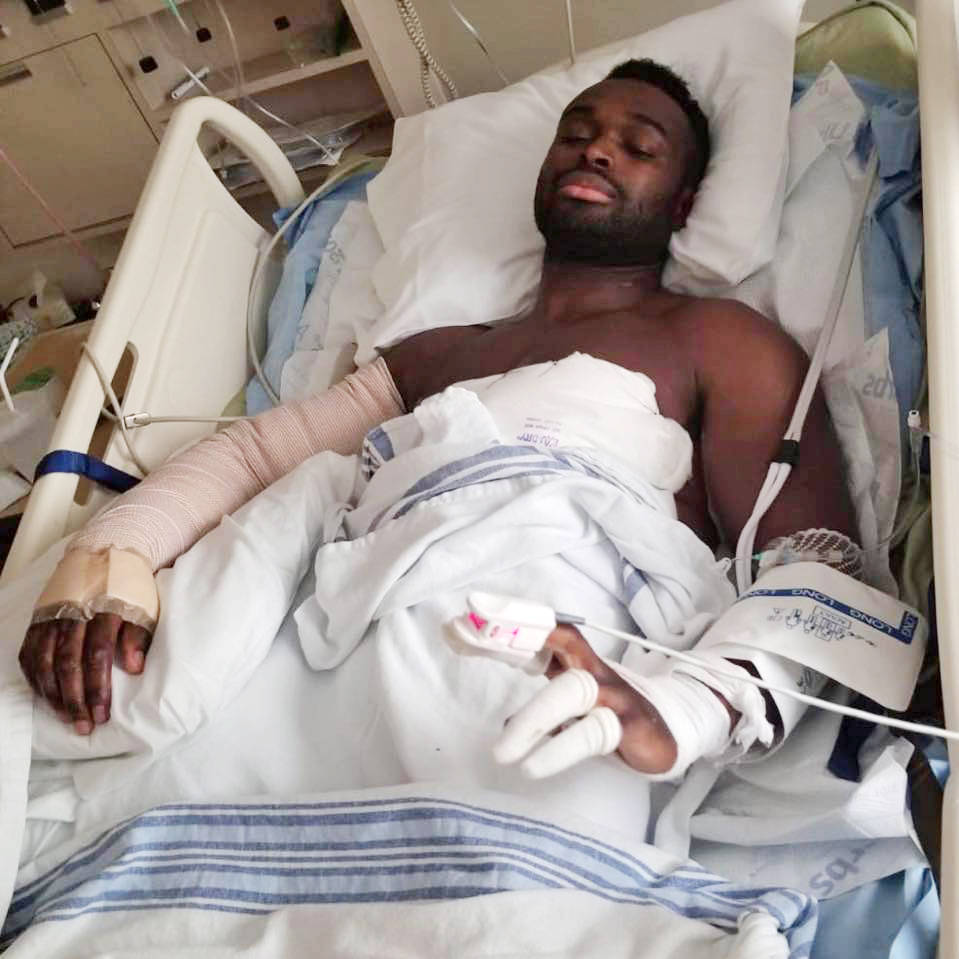 Harold Duncan-Williams suffered first, second and third degree burns when his shirt caught on fire at Alouette Lake over the May long weekend. Submitted photo