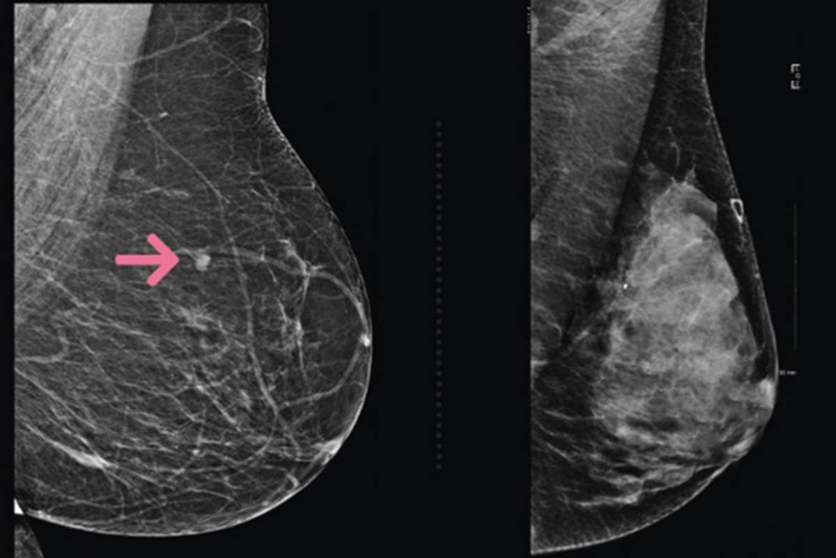 Breast density to be included in mammogram results across B.C.