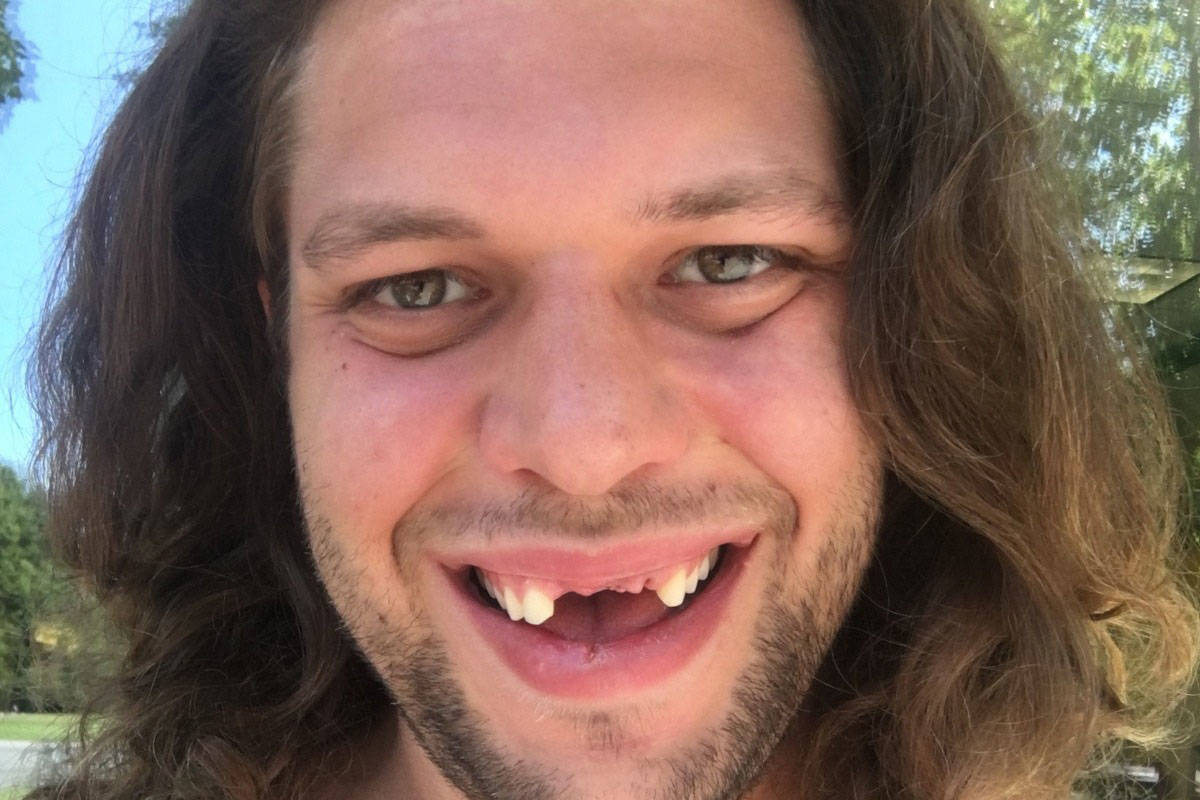 Taylor Fawcett’s smile reveals where he lost his three front teeth after a fainting spell in July. (GoFundMe photo)