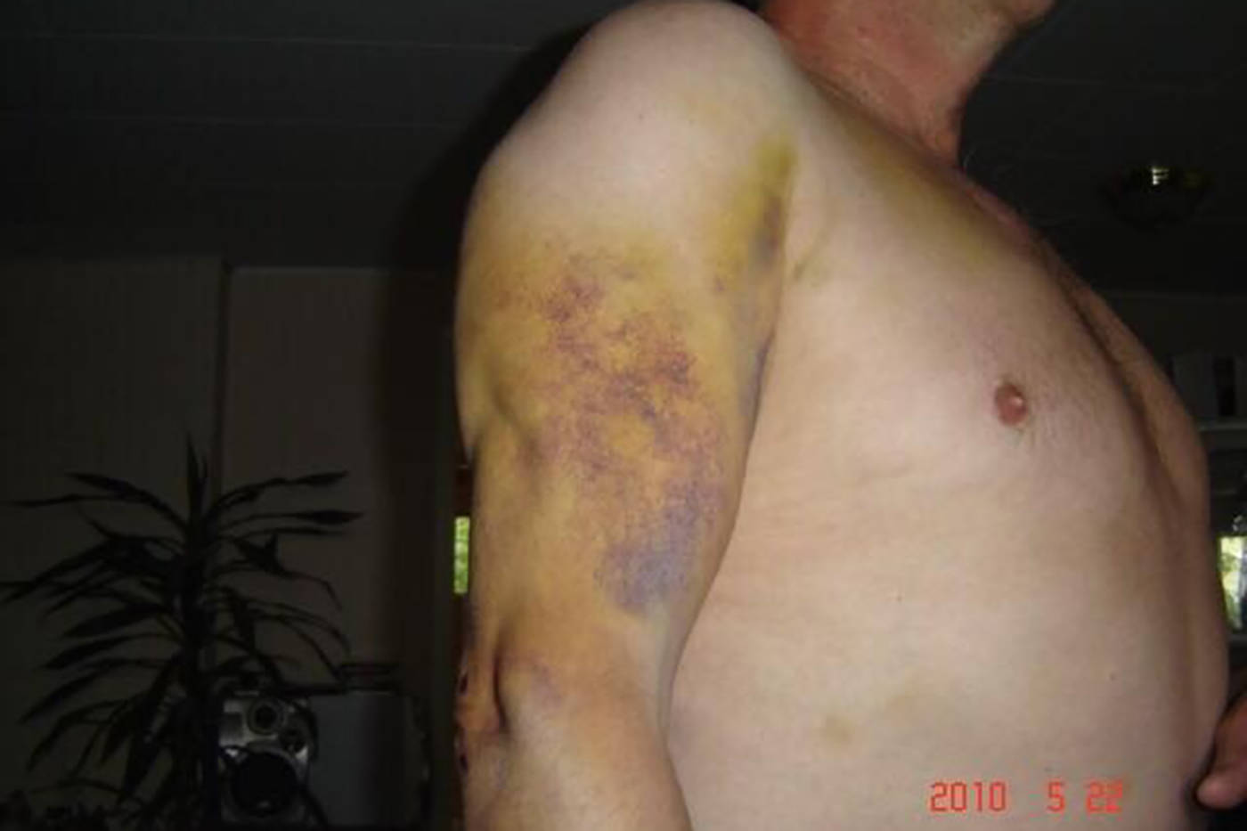 Photo taken of Lapshinoff’s injuries seven days after the excessive force arrest by Const. Brent Wray of Saanich Police. (Submitted)