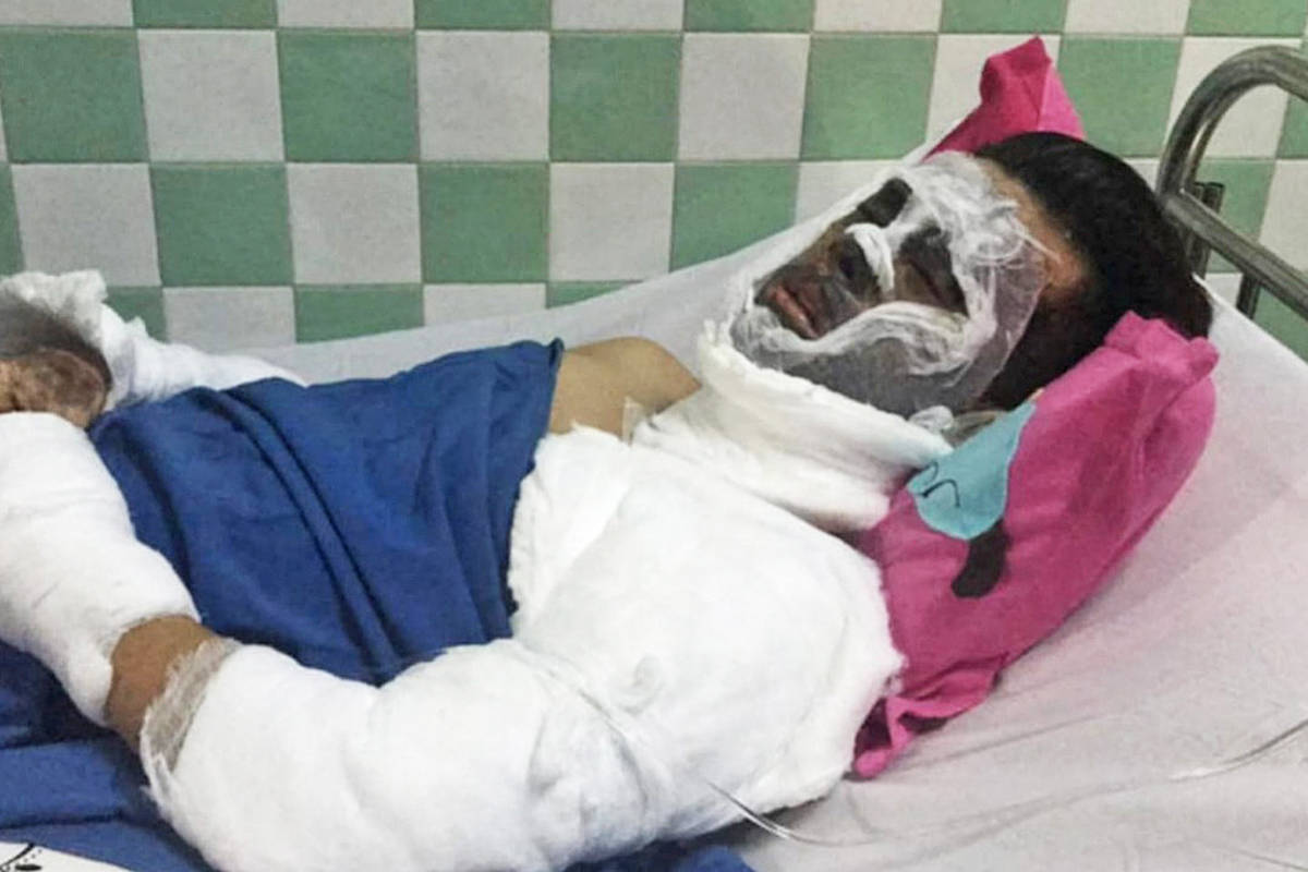 ‘Tom’ Nghiem Vo of Maple Ridge has suffered acid burns to most of his face and one eye. (Contributed)