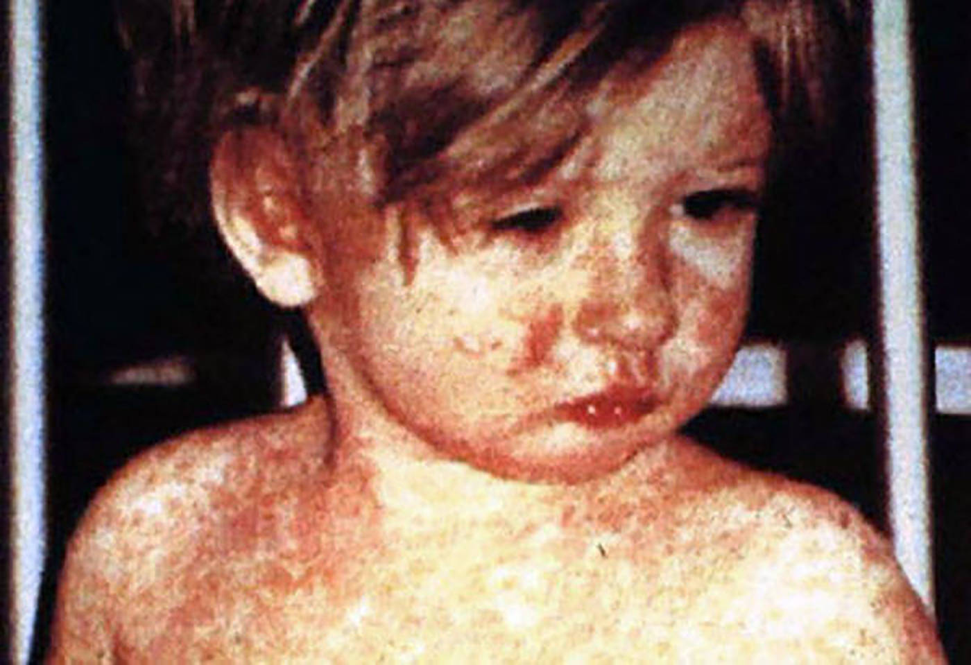 One new South Island measles exposure confirmed, for a total of six cases. (File photo)