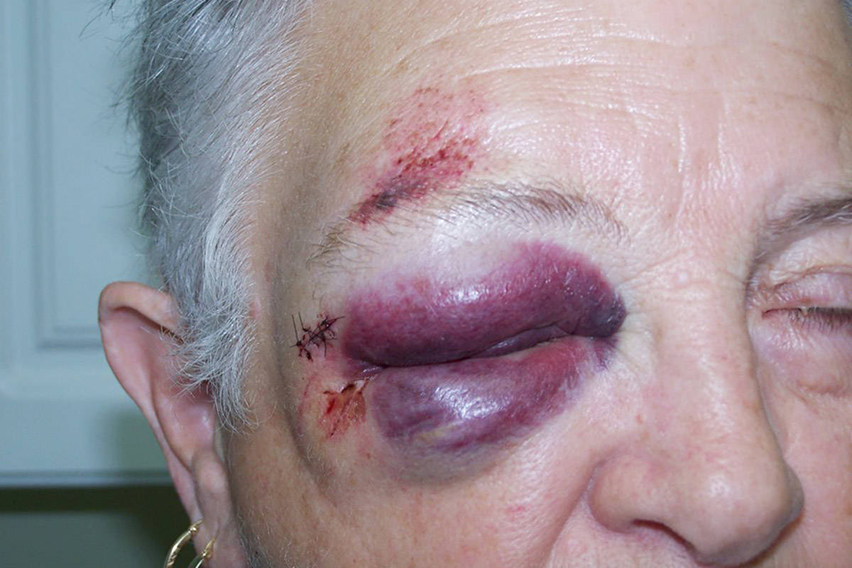 A photo posted to social media last week shows Gloria Klettke, 71, after the leash of a dog running free at Tyee Spit in Campbell River became tangled around her legs, causing her to fall.