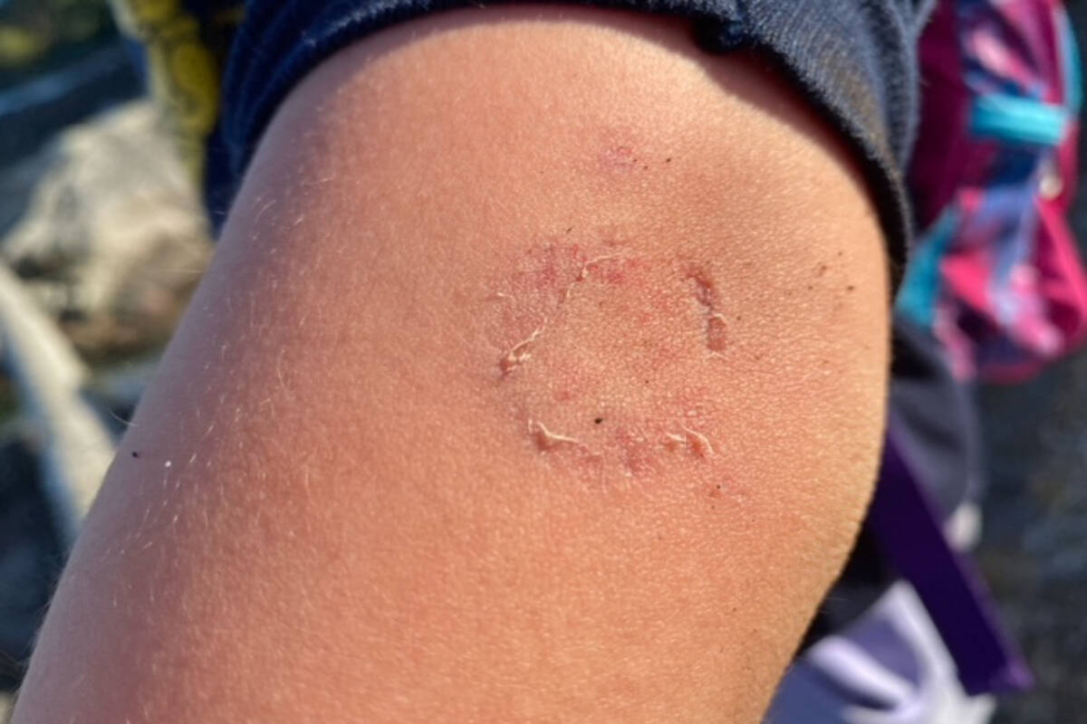 Mercy Liu’s right upper arm after being bitten by an unleashed dog in Balmacarra Park in Saanich. (Courtesy Bill Liu)