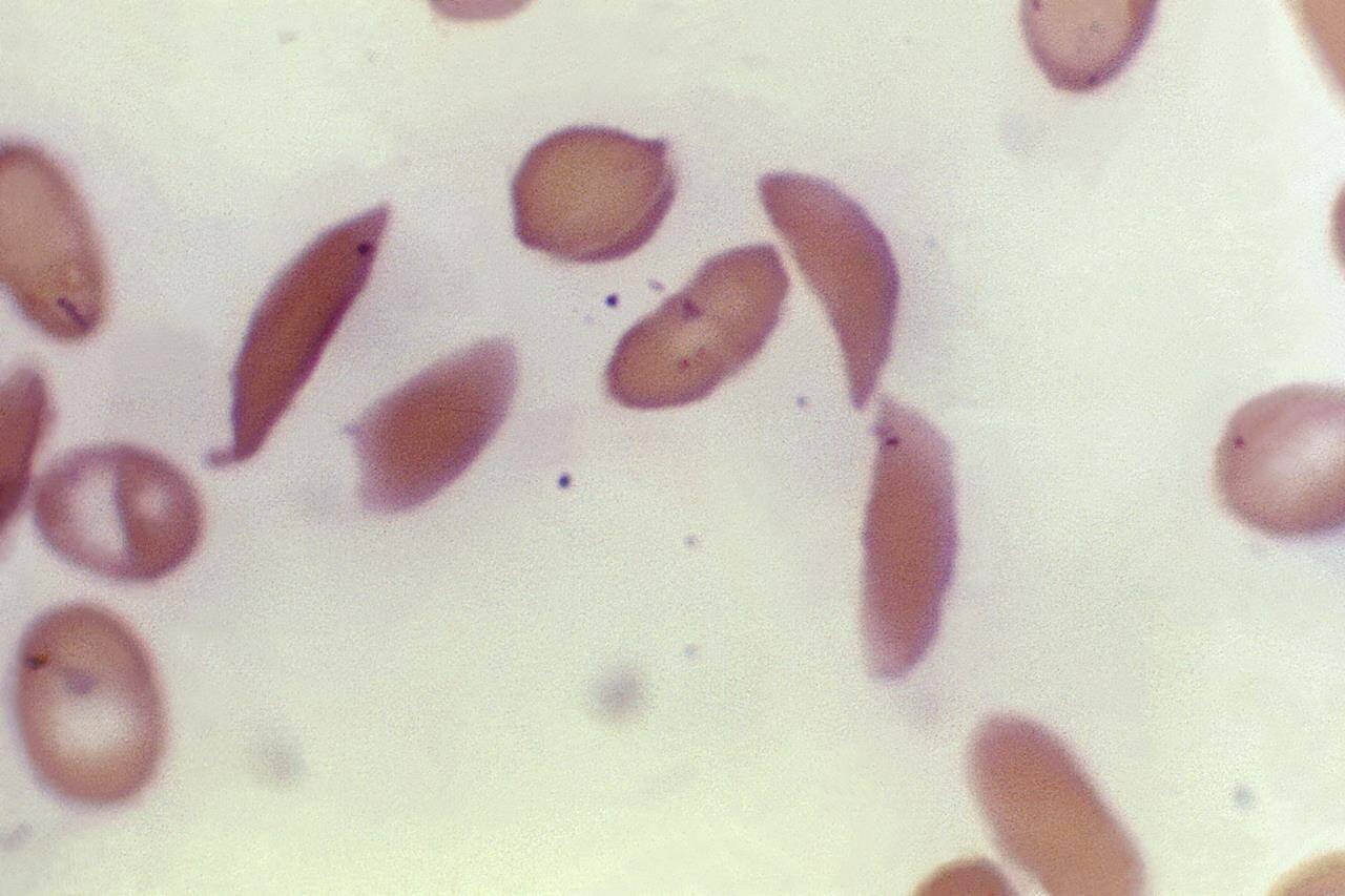 FILE - This microscope photo provided on Oct. 25, 2023, by the Centers for Disease Control and Prevention shows crescent-shaped red blood cells from a sickle cell disease patient in 1972. Britain’s medicines regulator has authorized the world’s first gene therapy treatment for sickle cell disease, in a move that could offer relief to thousands of people with the crippling disease in the U.K. In a statement on Thursday, Nov. 16, 2023, the Medicines and Healthcare Regulatory Agency said it approved Casgevy, the first medicine licensed using the gene editing tool CRISPR, which won its makers a Nobel prize in 2020. (Dr. F. Gilbert/CDC via AP, File )